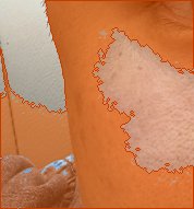 왼쪽 광대 색소 오버레이