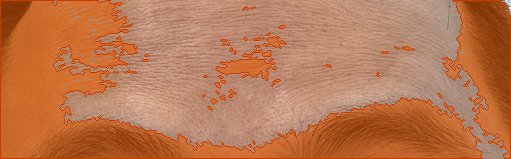 이마 색소 오버레이