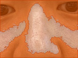 콧등 색소 오버레이