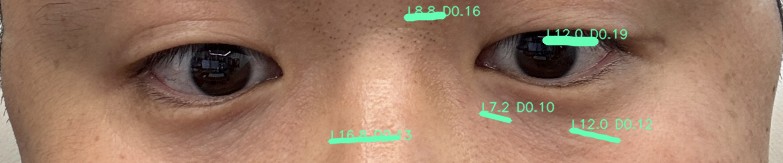 눈가 주름 오버레이