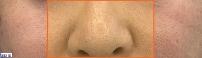 팔자주름 원본 크롭