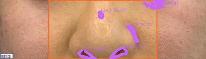 팔자주름 주름 오버레이