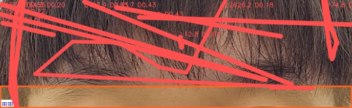 이마 주름 오버레이