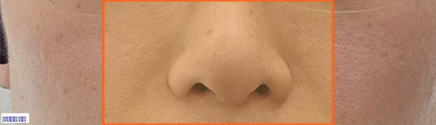 팔자주름 원본 크롭