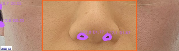 팔자주름 주름 오버레이