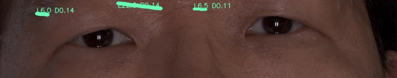 눈가 주름 오버레이