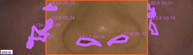 팔자주름 주름 오버레이