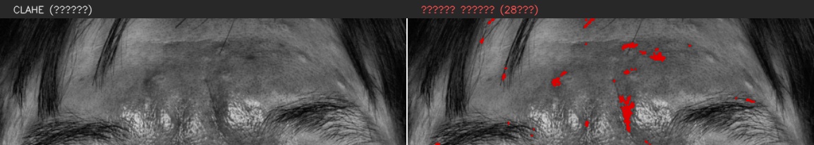 ④ 이마 — 모공 검출