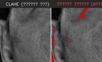 ⑥ 왼쪽 볼 — 모공 검출