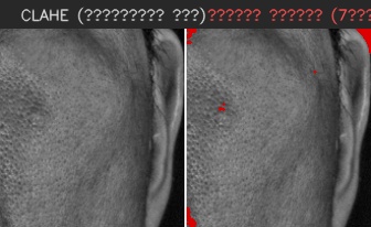 ⑦ 오른쪽 볼 — 모공 검출