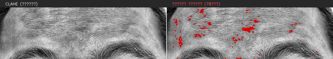 ④ 이마 — 모공 검출