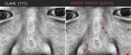 ⑤ 코 — 모공 검출