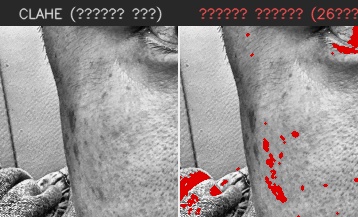 ⑥ 왼쪽 볼 — 모공 검출