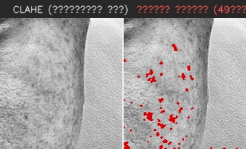 ⑦ 오른쪽 볼 — 모공 검출