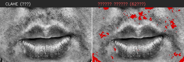 ⑧ 턱 — 모공 검출