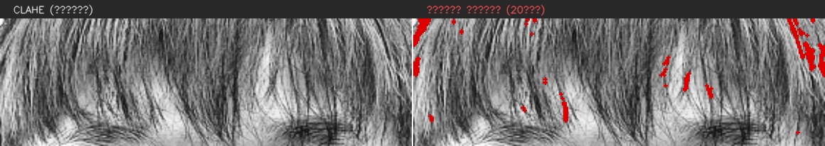 ④ 이마 — 모공 검출