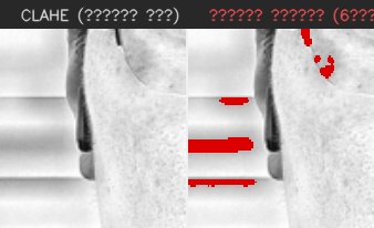 ⑥ 왼쪽 볼 — 모공 검출